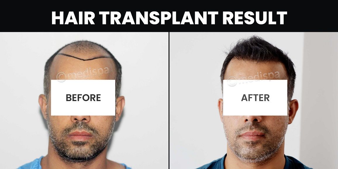 All You Need To Know About Male Pattern Baldness And Its Treatment