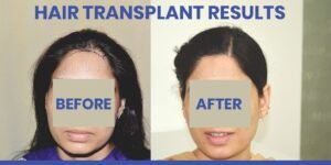 Explain The Significance of Female Hair Transplant