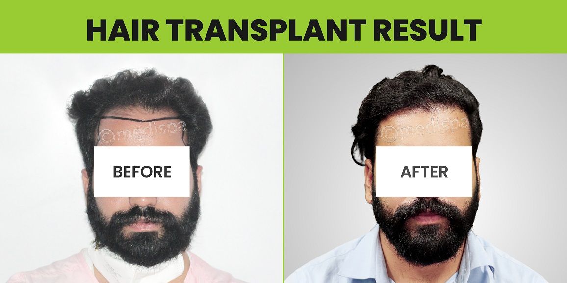 What Are The Key Indicators Of A Successful Hair Transplant?