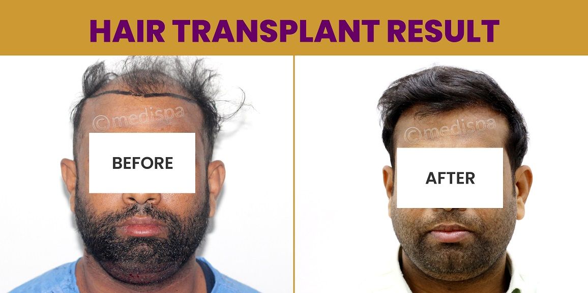 Is Hair Restoration An Effective Solution For Androgenetic Alopecia?
