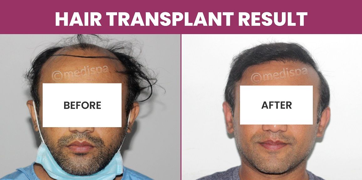 Can Hair Transplantation Successfully Restore Hair Growth?