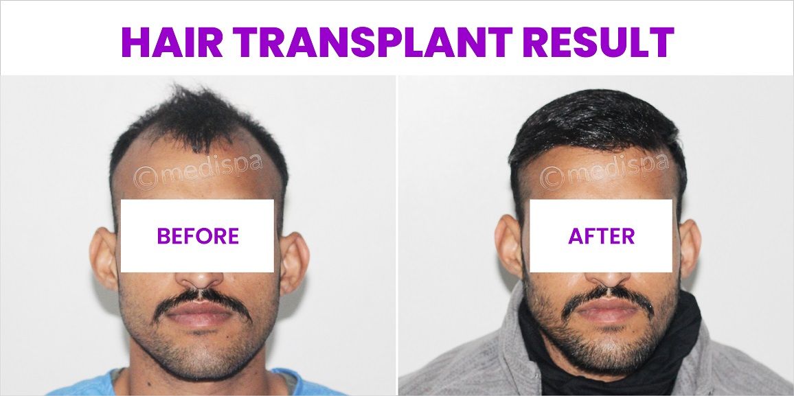 From Thinning To Thickening: Why Hair Transplant Is The Top Choice For Hair Loss