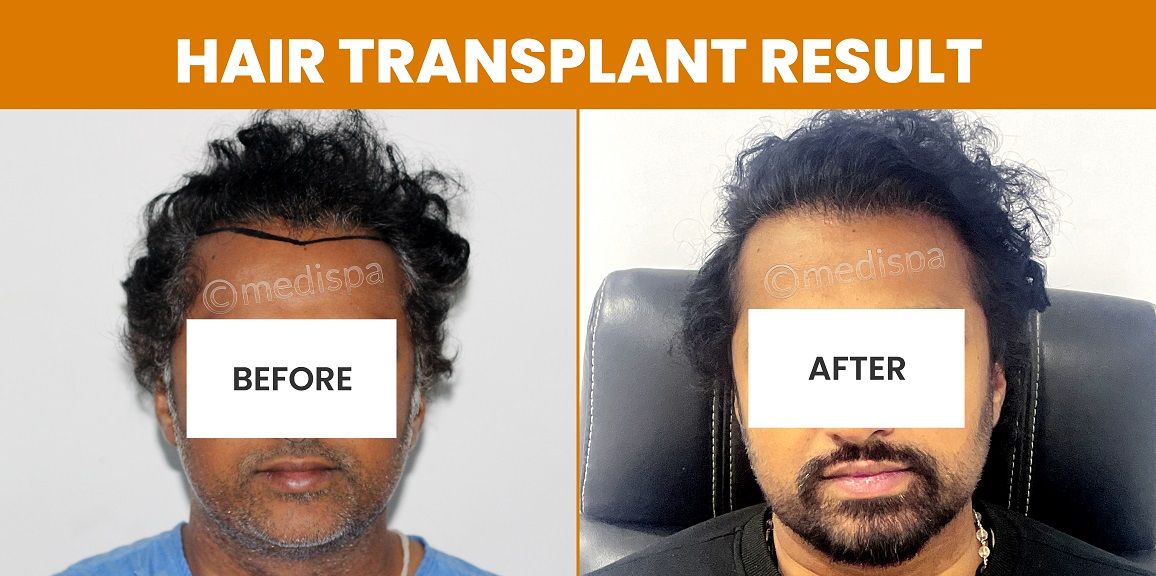 How To Evaluate The Effectiveness Of Hair Restoration?