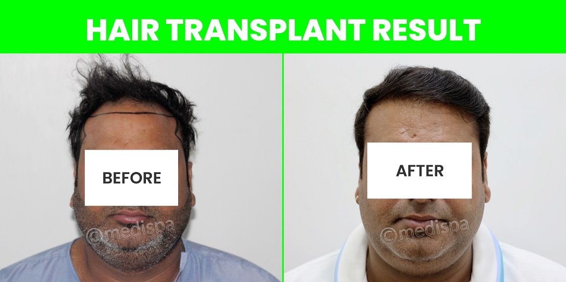 Considering Hair Transplantation? Here Are The Important Factors To Evaluate