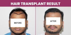 Maximizing Results, Minimizing Risks: The Key To A Successful Hair Transplant