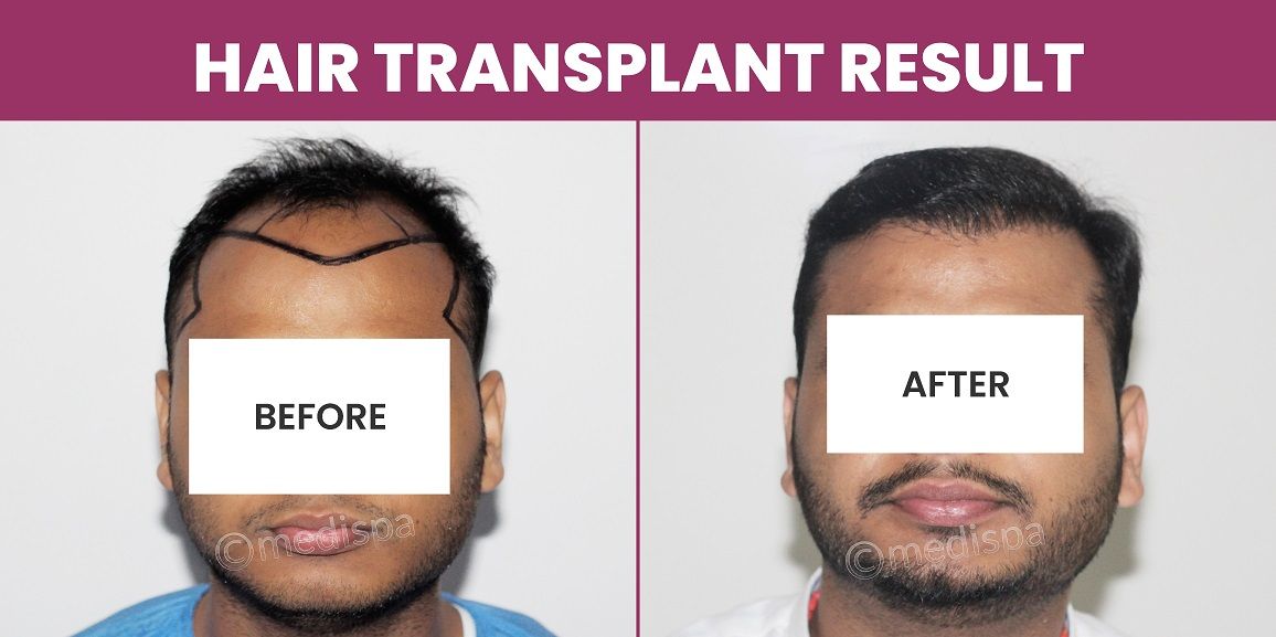 Maximizing Results, Minimizing Risks: The Key To A Successful Hair Transplant
