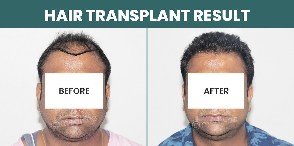 Is Hair Transplantation The Best Solution For Hair Loss?