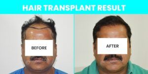 How To Get The Best Hair Transplant Results Without Pain And Scars?