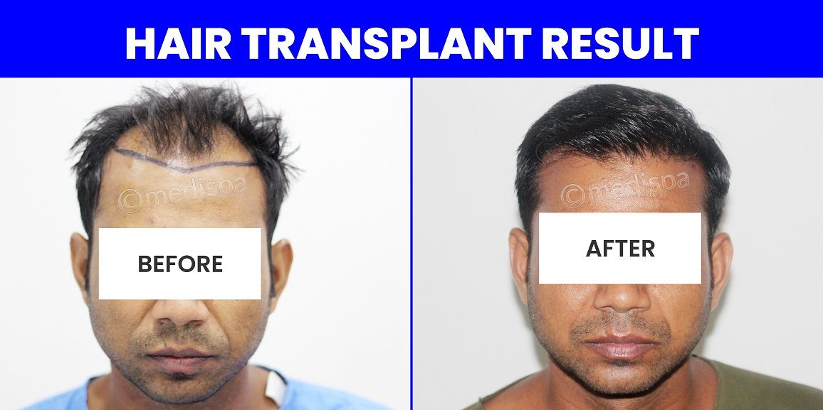 Hair Transplantation Techniques: What Works Best For A Natural-Looking Hairline