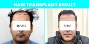 Hair Restoration – Is It The Permanent Solution To Cure Baldness?
