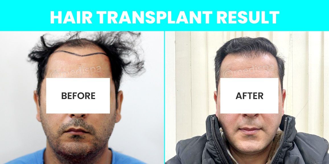 Hair Restoration – Is It The Permanent Solution To Cure Baldness?