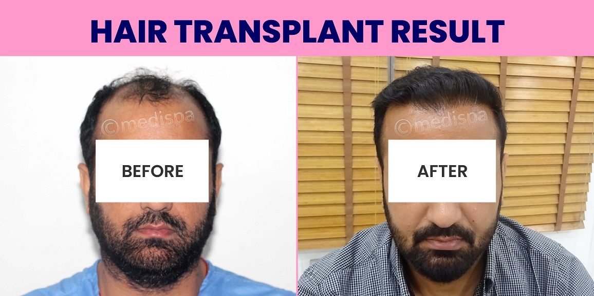 Importance and Need of Hair Graft Calculator