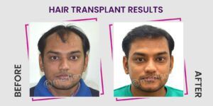 Things To Consider Before Choosing The Best Hair Transplant Clinic