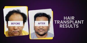 How To Determine Per Graft Cost For Hair Restoration?
