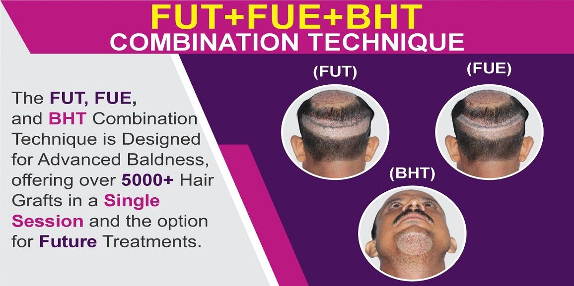 Explain The Effectiveness Of FUE+FUT+BHT Combination Hair Transplant Technique