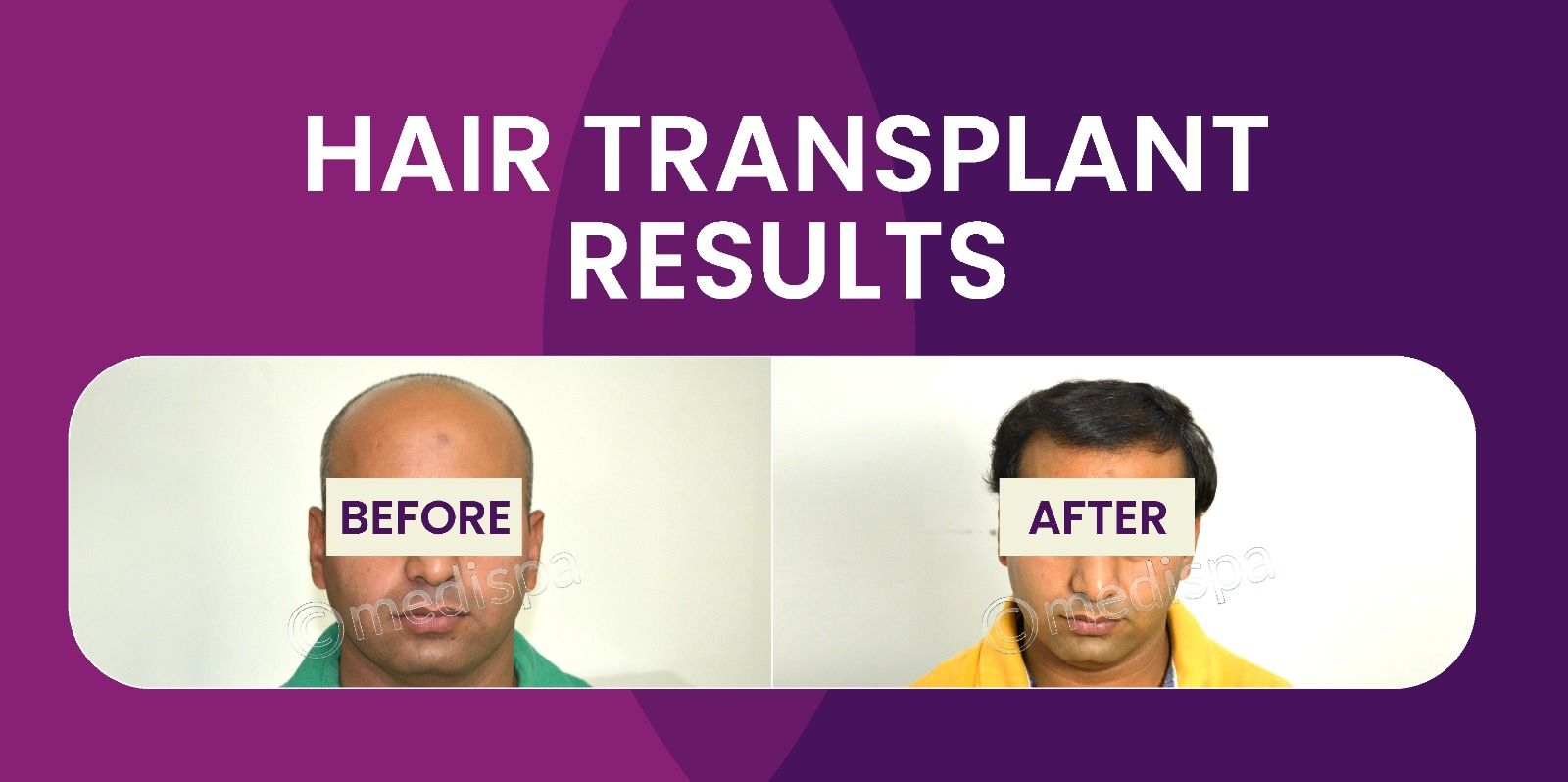 Aspects To Consider While Choosing The Best Hair Transplant Surgeon