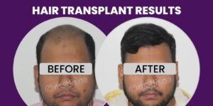 Precautions To Be Taken Before And After Hair Transplant