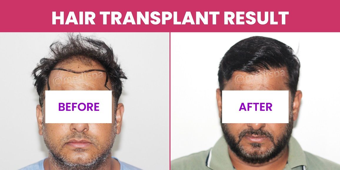 What To Do After A Failed Hair Transplant?