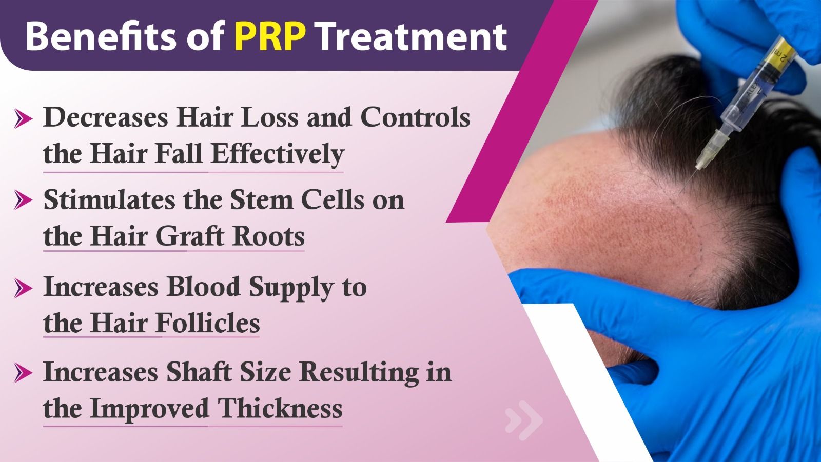 Explain the significance of PRP Hair Restoration
