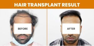 Does Hair Transplant Leave Scar After The Procedure?