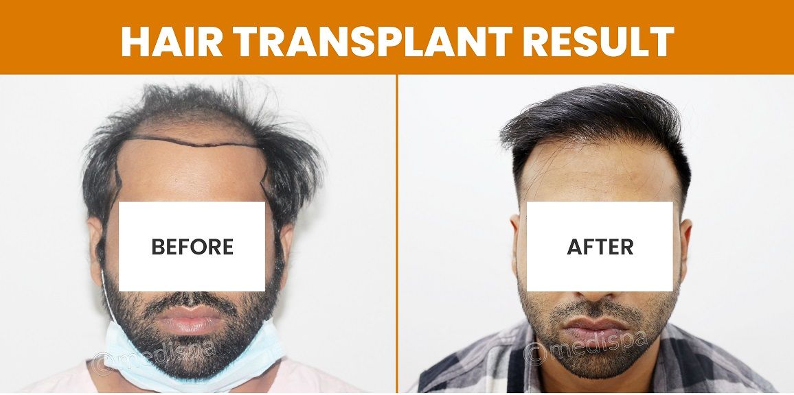 Does Hair Transplant Leave Scar After The Procedure?