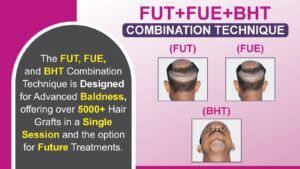 FUT+FUE+BHT Combined Hair Transplant Vs Other Methods