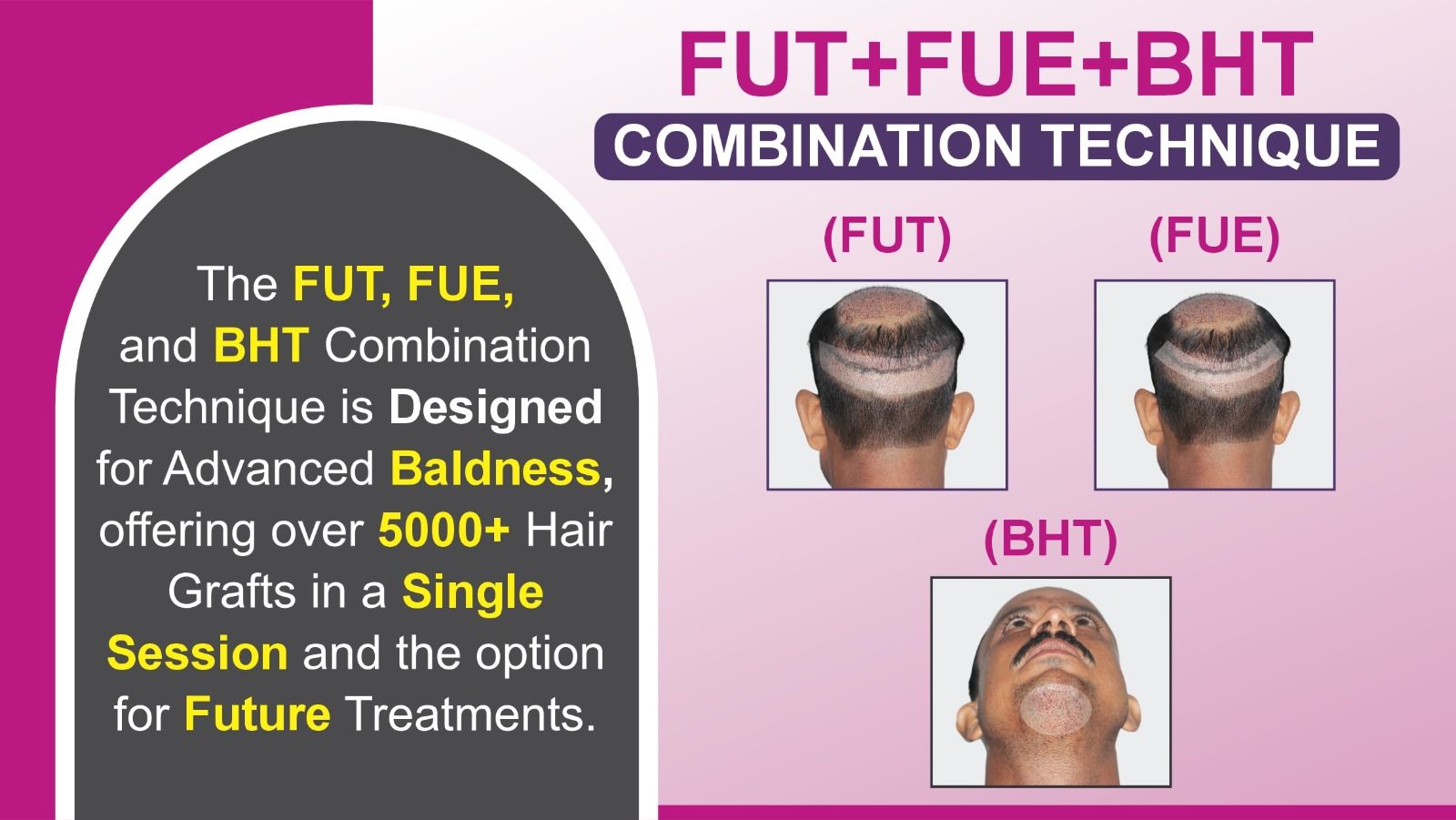 FUT+FUE+BHT Combined Hair Transplant Vs Other Methods