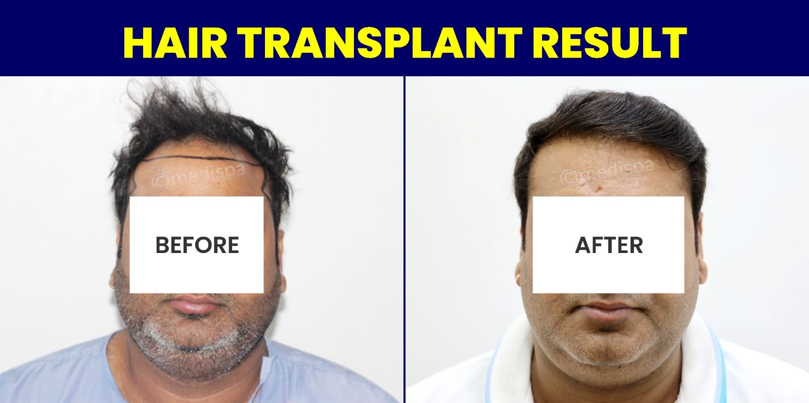 How To Maximise The Hair Growth Rate After Hair Transplant Surgery?
