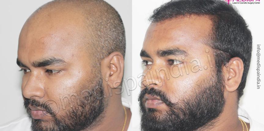 hair restoration results dubai