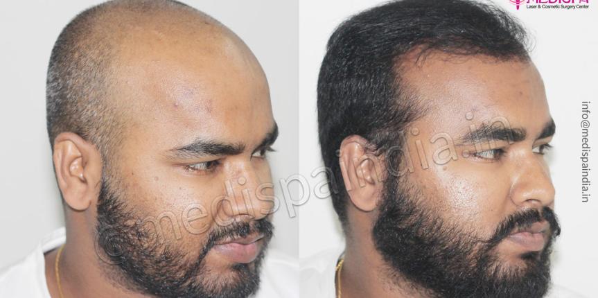 hair restoration results jaipur