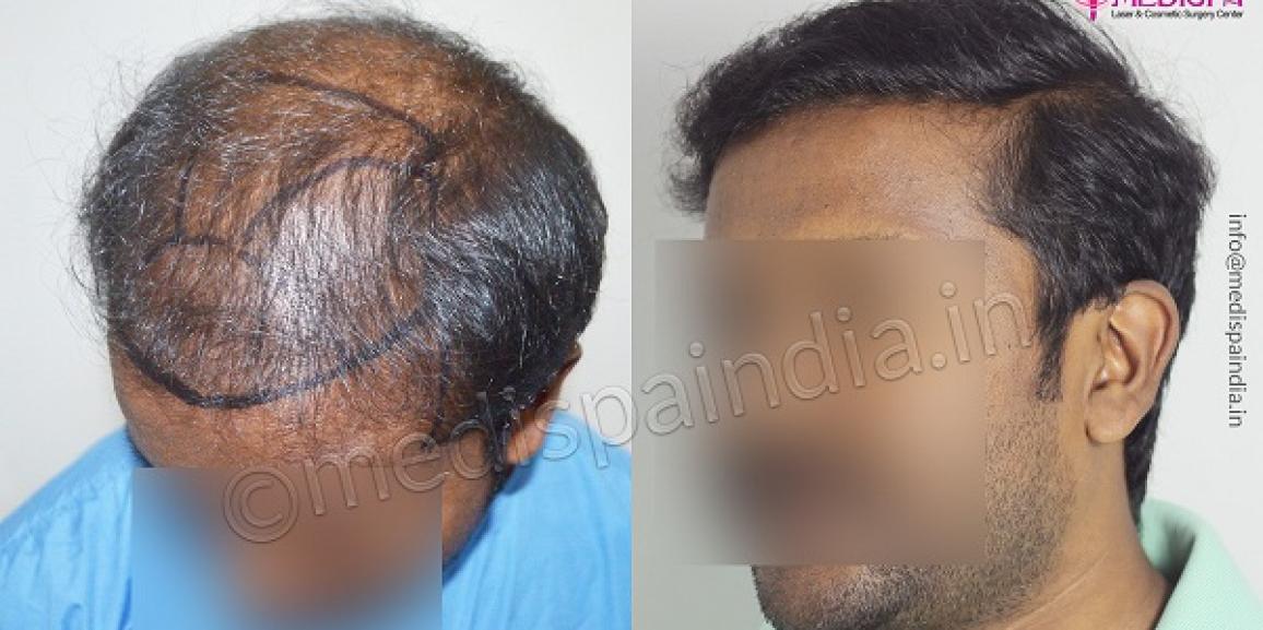 How To Define The Success of A Hair Transplant Procedure?