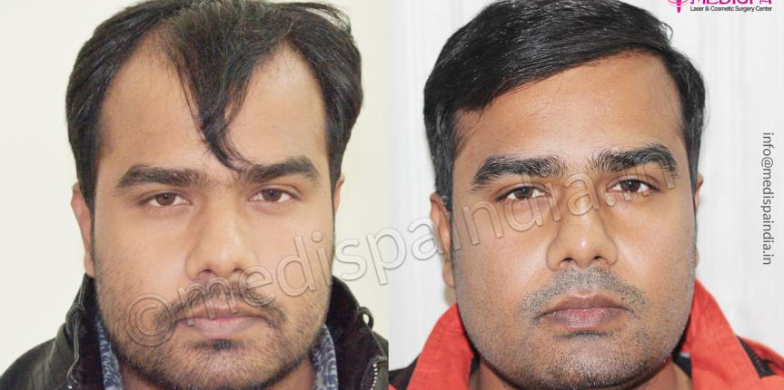 hair transplant chennai