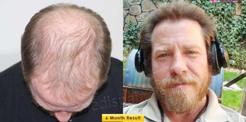 hair transplant results usa
