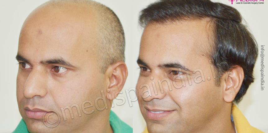 hair transplant in nigeria
