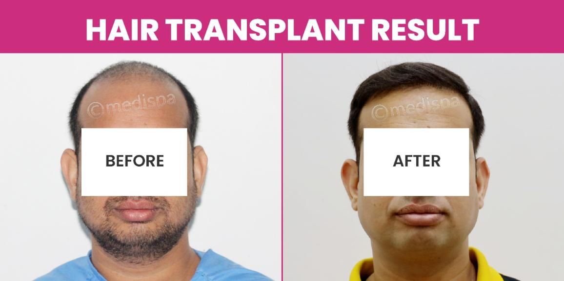 Things To Know Before Undergoing Hair Transplant Surgery