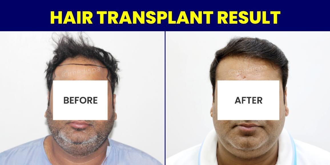 How To Maximise The Hair Growth Rate After Hair Transplant Surgery?