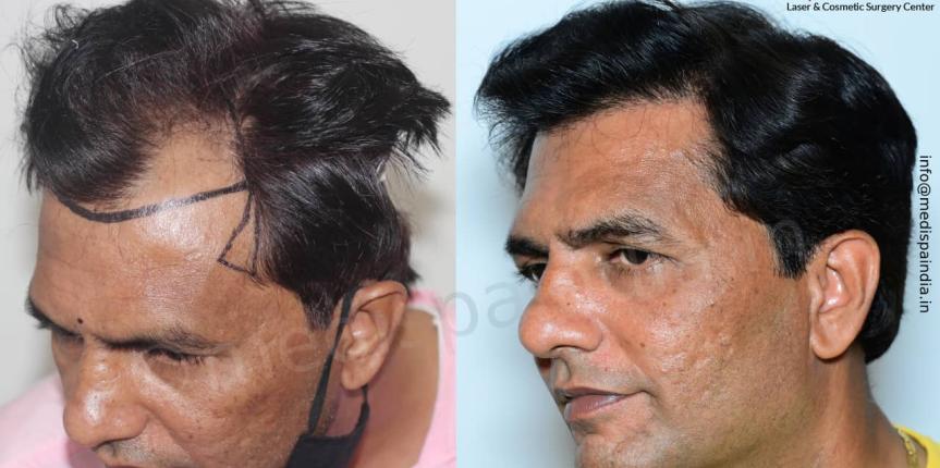 hair transplant surgeon