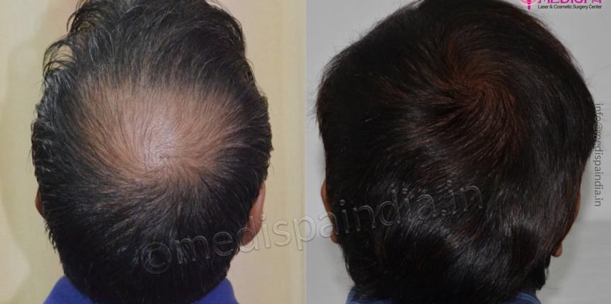crown hair transplant india