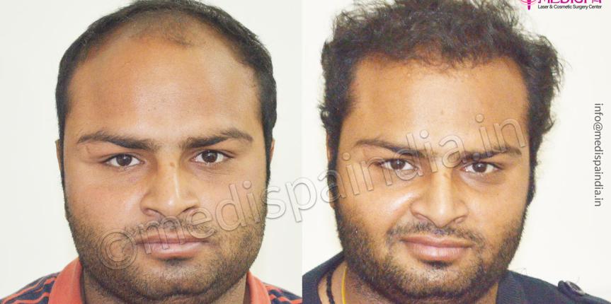 hair transplant clinics in greater kailash