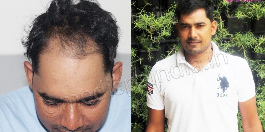 hair transplant clinics results delhi