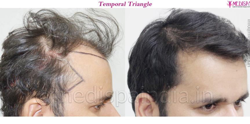 australia hair transplant cost