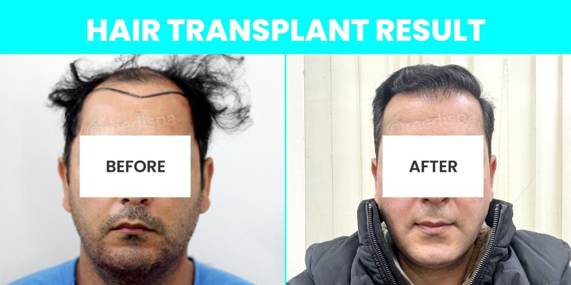Hair Restoration – Is It The Permanent Solution To Cure Baldness?