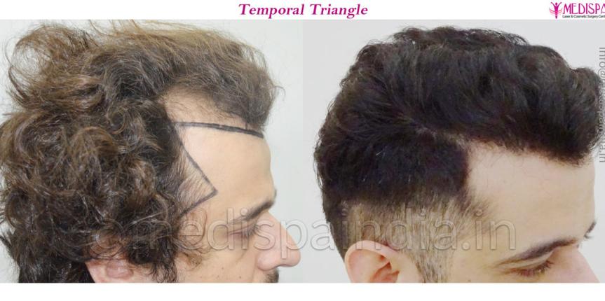 hair transplant in california