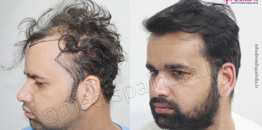 hair transplant clinics in sydney australia