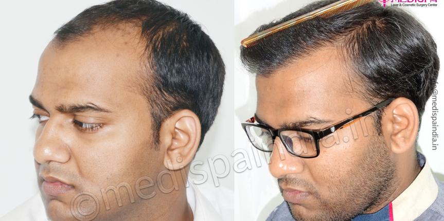 hair transplant doctors in jaipur rajasthan