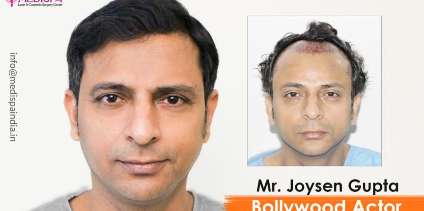 bollywood actor joysen gupta hair transplant