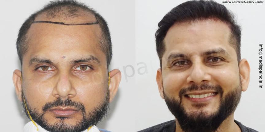 hair transplant in india