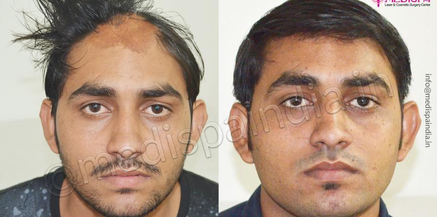 burn hair transplant correction delhi