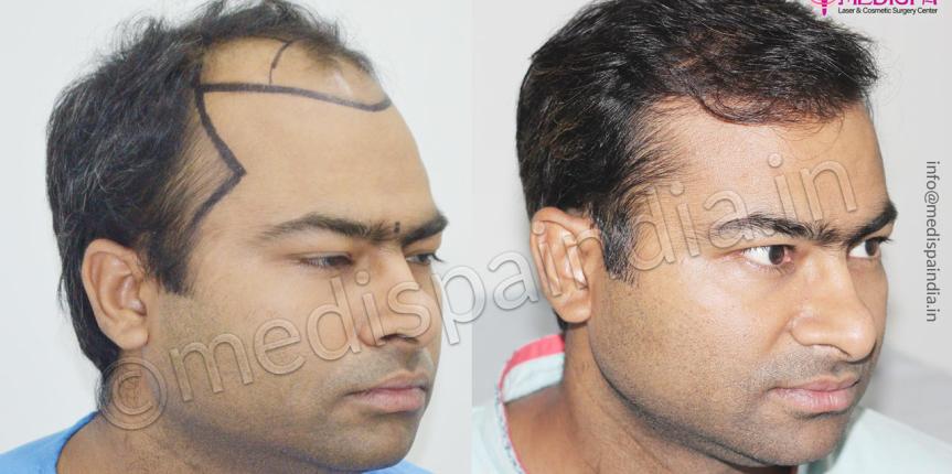 hair transplant results usa