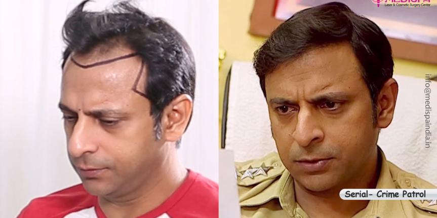 joysen gupta hair transplant results